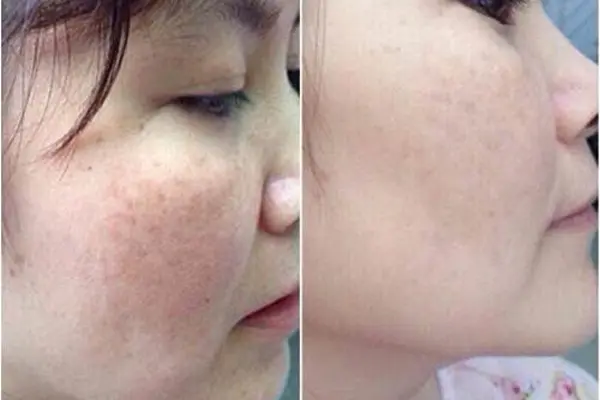 Trị Nám 1 Trước và sau Trị Nám & Tàn nhan tại Thiên Ân