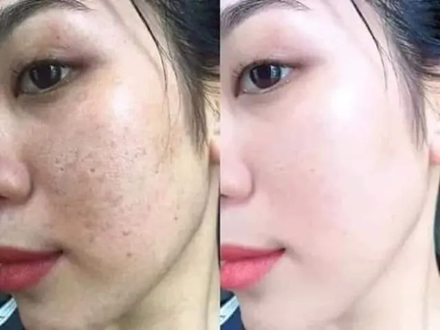 Trị Nám 2 Trước và saau trị nắm tại Thiên An Spa